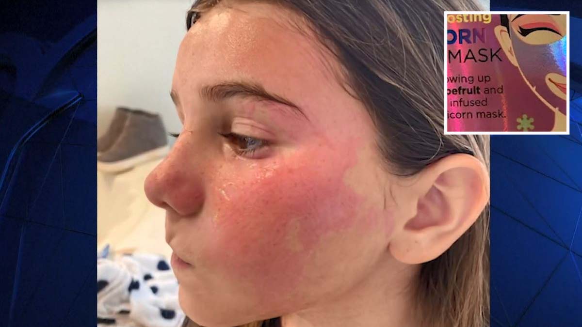 Niña sufre alergia por mascarilla facial que le regalaron