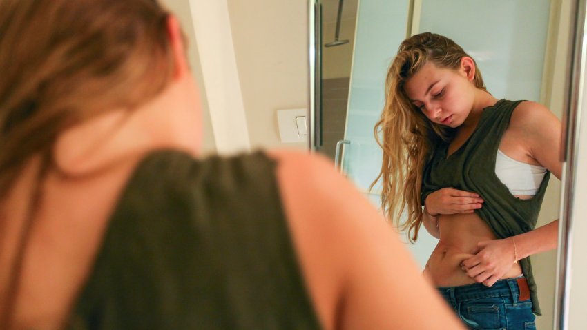 Young Woman pinching her waist. She may be keeping track of weight loss during a diet but compulsive body analysis may be a symptom of a body image disorder such as anorexia nervosa. Model released