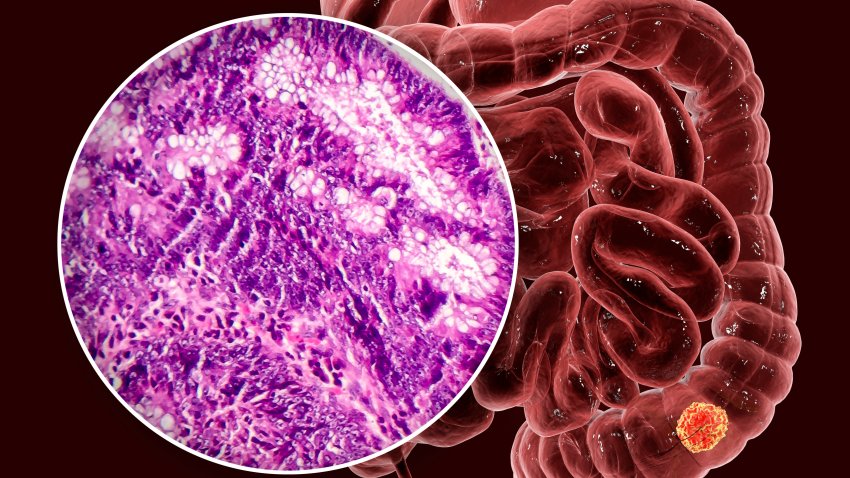 Colon cancer, computer illustration and light micrograph showing colon adenocarcinoma.