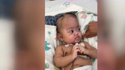 Pequeño de 5 meses nace con extraño síndrome en el condado Merced